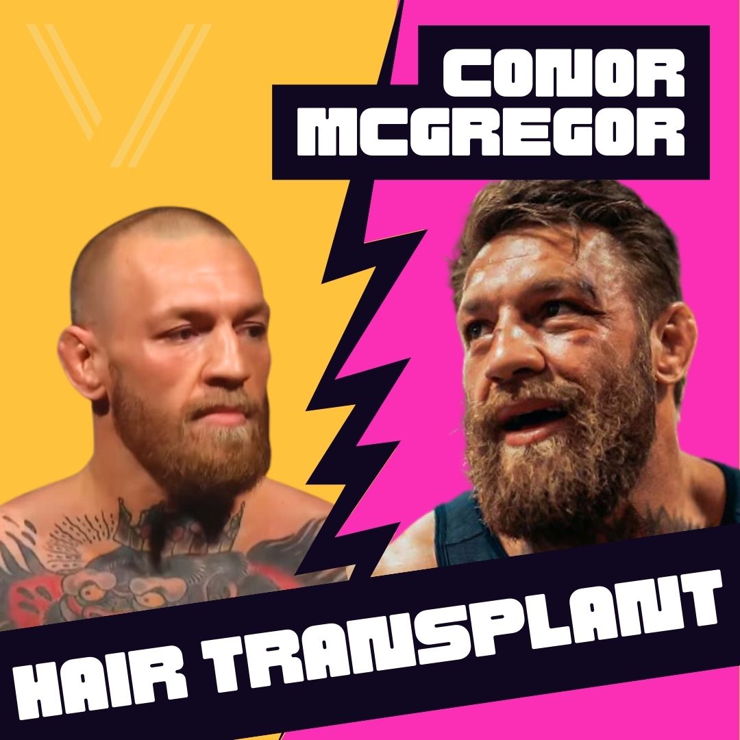 McGregor Hair Transplant: Did He or Didnt He Get One?