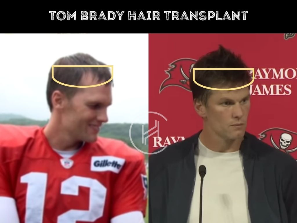 Tom Brady Hair Restoration: What Procedures Has He Had?