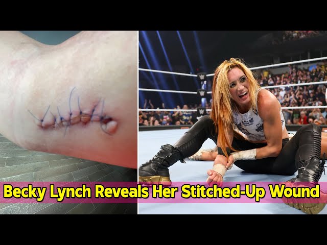 Becky Lynch stitches: The Man reveals all about her latest battle scars and recovery.