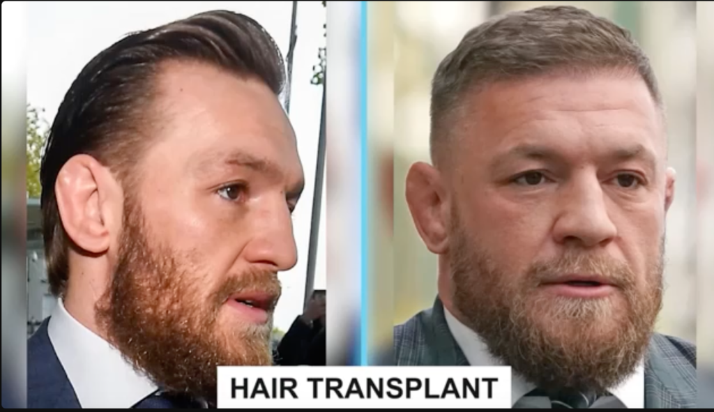 McGregor Hair Transplant: Did He or Didnt He Get One?