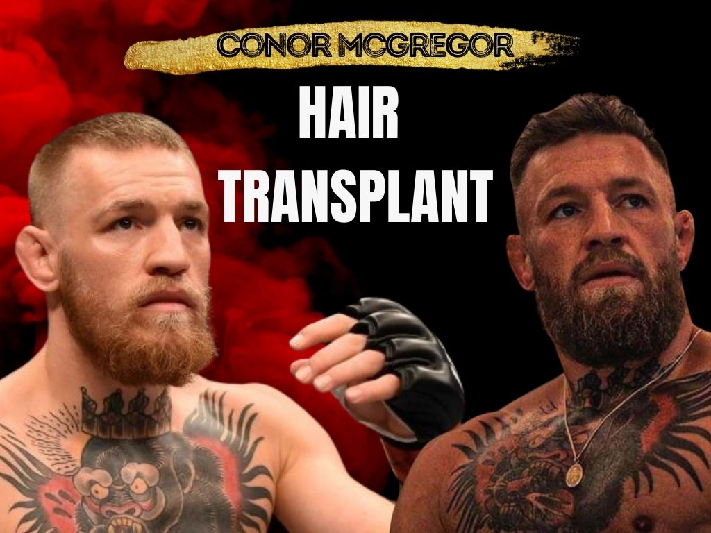 Connor McGregor Hair Transplant: Did He or Didnt He? - Heres the Real Deal