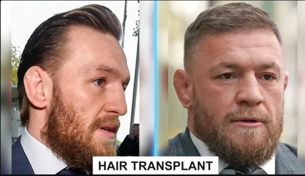 Connor McGregor Hair Transplant: Did He or Didnt He? - Heres the Real Deal