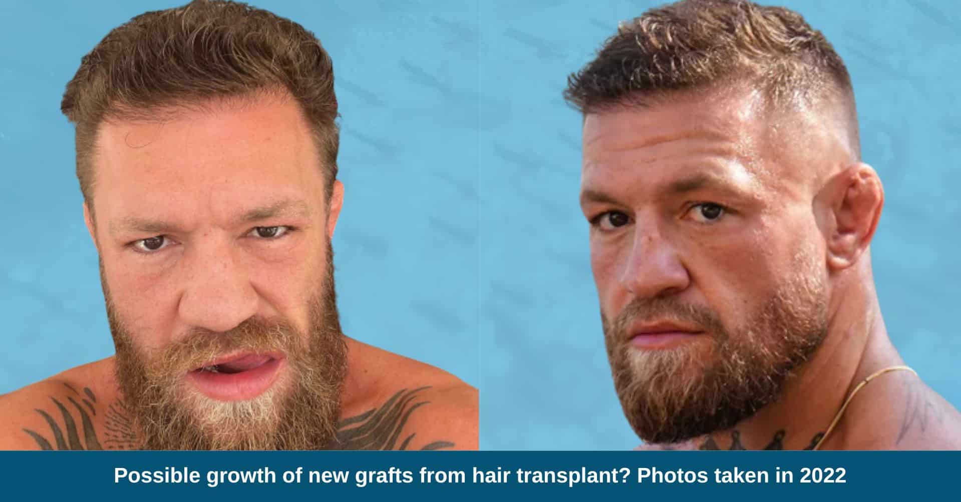 Conor McGregor Hairline: Then and Now!  Check Out the Changes Over the Years!