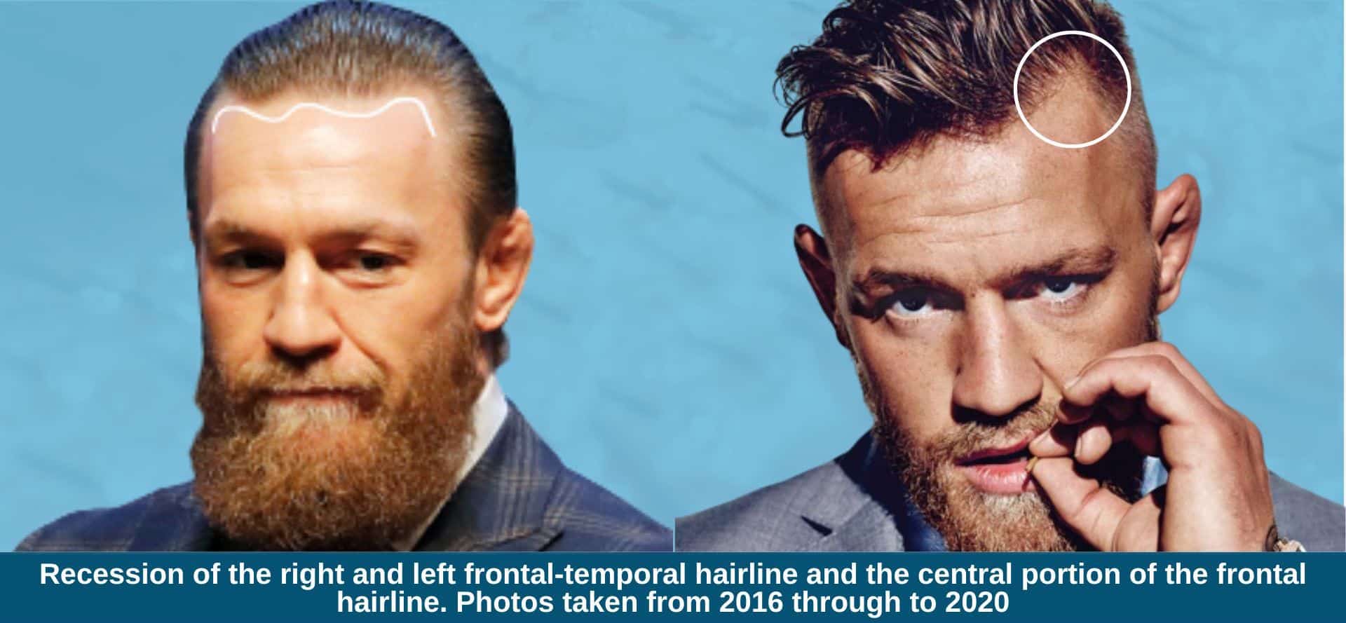 Conor McGregor Hairline: Then and Now!  Check Out the Changes Over the Years!