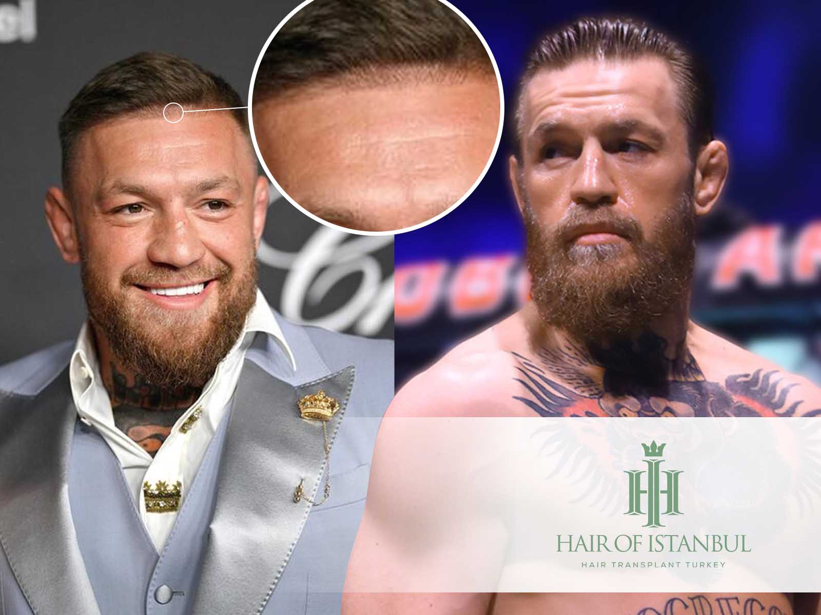 Conor McGregors Hair: Transplant Truths and Timeline of His Changing Look.